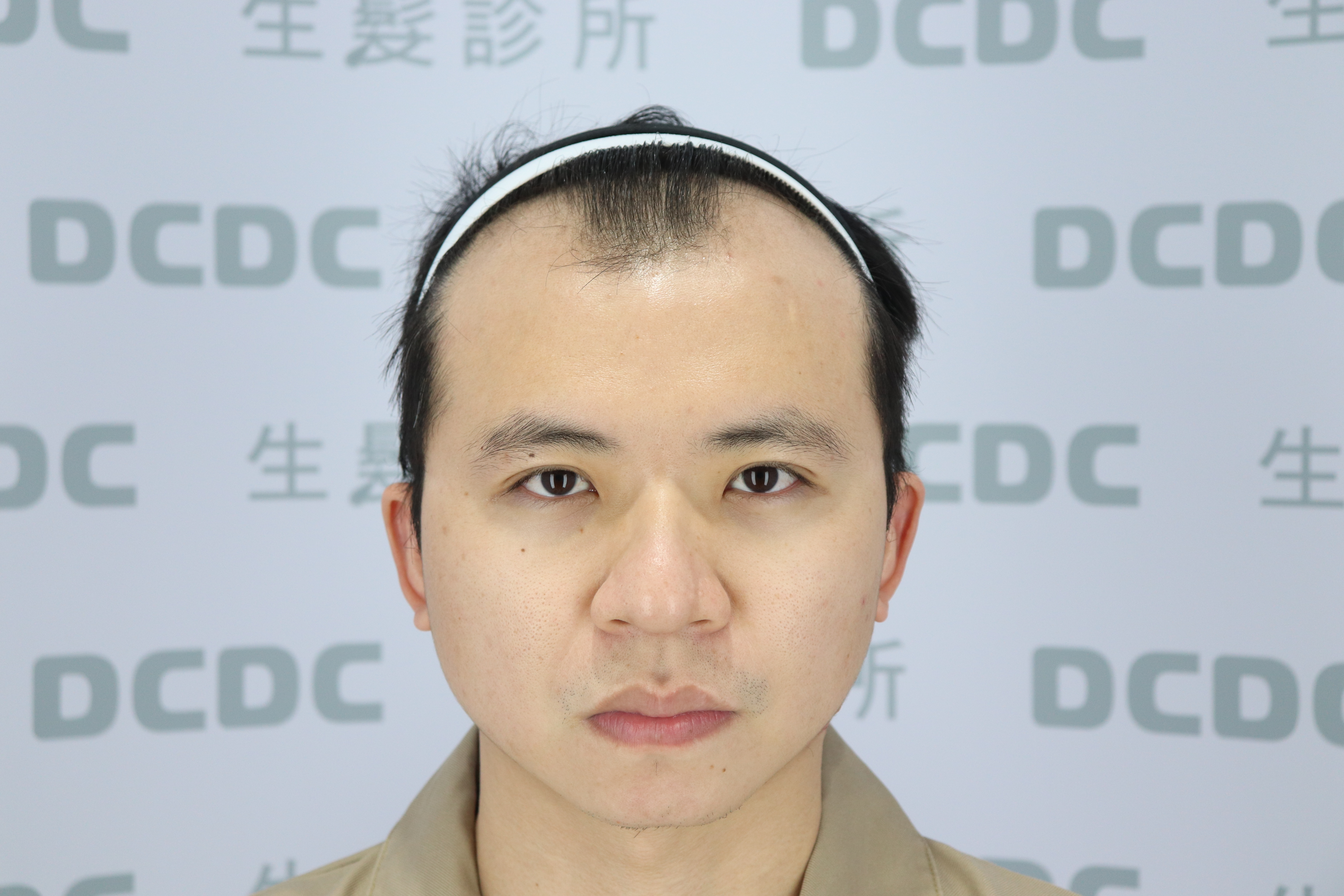 DCDC生髮診所-方孝俤醫師嚴重M型禿前額植髮術前正面評估